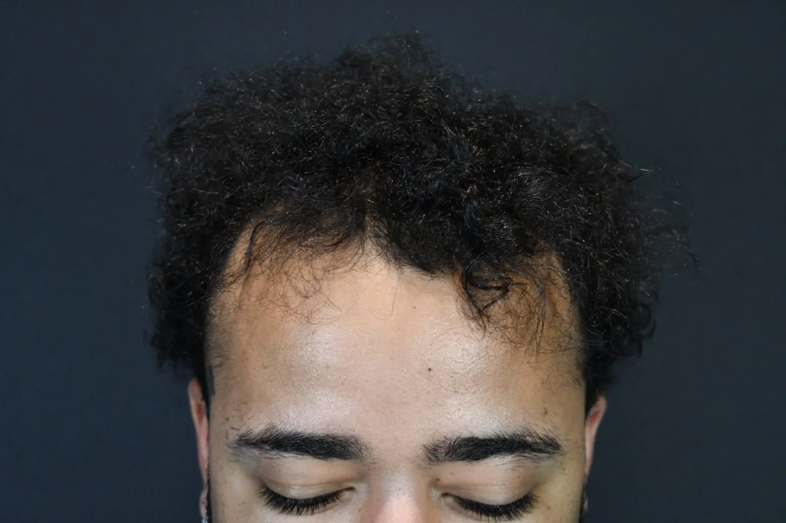 Man with receding hairline and visible hair loss on scalp